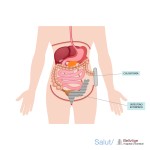 Bolsa de colostomía drenable